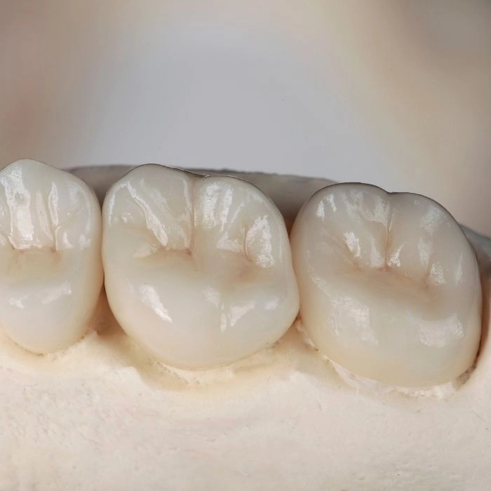 tooth sealants in West Jordan UT applied during dental visit diagram